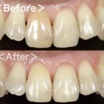 ビフォーアフター画像【症例】神経が死んでしまい、変色した歯に対するホワイトニング｜港南台の歯医者 港南台パーク歯科クリニック