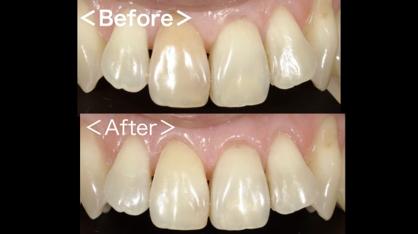 ビフォーアフター画像【症例】神経が死んでしまい、変色した歯に対するホワイトニング｜港南台の歯医者 港南台パーク歯科クリニック
