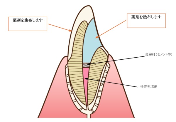 インターナルブリーチの下準備｜【症例】神経が死んでしまい、変色した歯に対するホワイトニング｜港南台の歯医者 港南台パーク歯科クリニック