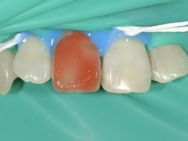 ラバーダムで保護している様子｜【症例】神経が死んでしまい、変色した歯に対するホワイトニング｜港南台の歯医者 港南台パーク歯科クリニック