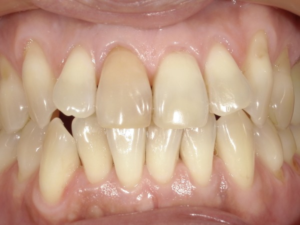 ビフォー画像｜【症例】神経が死んでしまい、変色した歯に対するホワイトニング｜港南台の歯医者 港南台パーク歯科クリニック