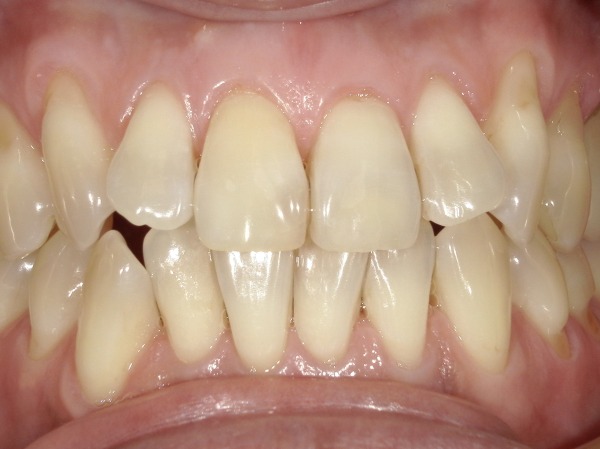 アフター画像｜【症例】神経が死んでしまい、変色した歯に対するホワイトニング｜港南台の歯医者 港南台パーク歯科クリニック