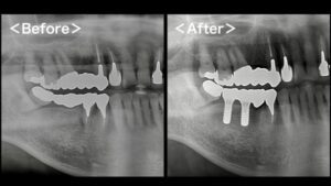 【症例】歯根破折したブリッジに対するインプラント治療