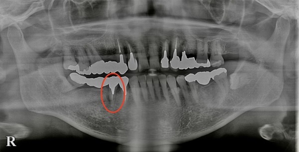 初診時のレントゲン写真|【症例】歯根破折したブリッジに対するインプラント治療|港南台の歯医者 港南台パーク歯科クリニック