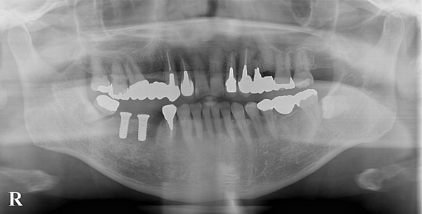 術後のレントゲン写真|【症例】歯根破折したブリッジに対するインプラント治療|港南台の歯医者 港南台パーク歯科クリニック