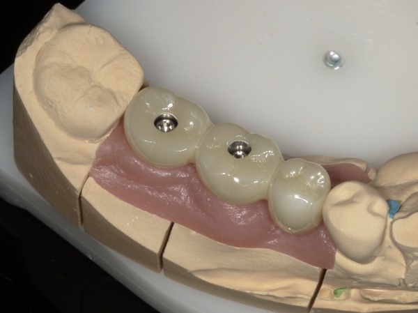 ジルコニアブリッジの写真|【症例】歯根破折したブリッジに対するインプラント治療|港南台の歯医者 港南台パーク歯科クリニック