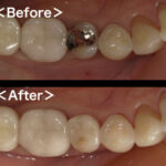 ビフォーアフター｜【症例】銀歯の下に潜んだ虫歯をセラミックインレー（e.max）で修復治療｜港南台の歯医者 港南台パーク歯科クリニック