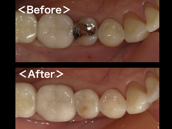 ビフォーアフター｜【症例】銀歯の下に潜んだ虫歯をセラミックインレー（e.max）で修復治療｜港南台の歯医者 港南台パーク歯科クリニック