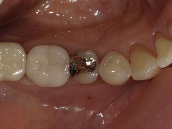 初診時｜【症例】銀歯の下に潜んだ虫歯をセラミックインレー（e.max）で修復治療｜港南台の歯医者 港南台パーク歯科クリニック