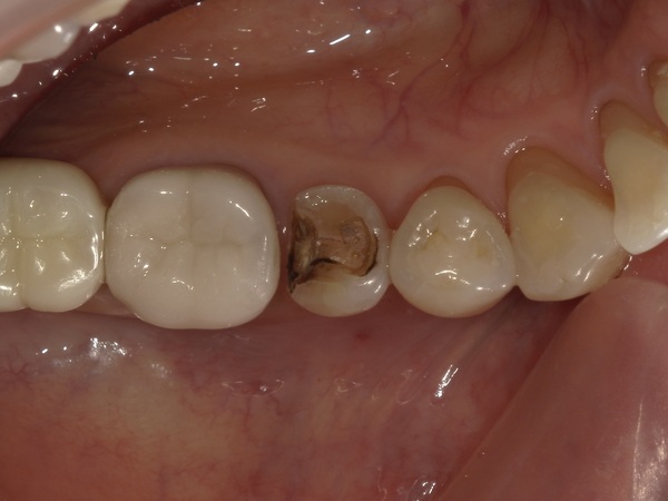 銀歯抜去後｜【症例】銀歯の下に潜んだ虫歯をセラミックインレー（e.max）で修復治療｜港南台の歯医者 港南台パーク歯科クリニック