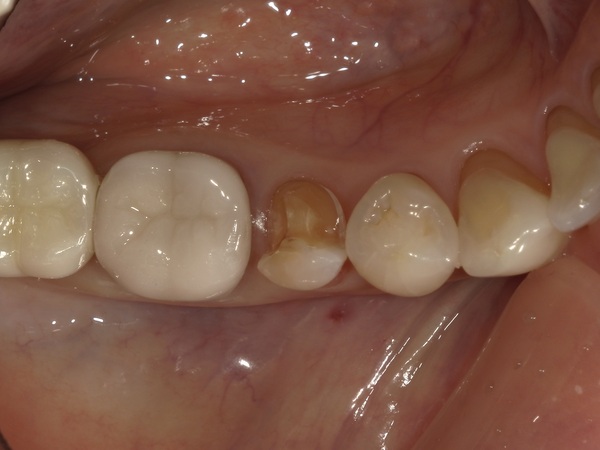型取り｜【症例】銀歯の下に潜んだ虫歯をセラミックインレー（e.max）で修復治療｜港南台の歯医者 港南台パーク歯科クリニック