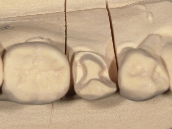 完成２｜【症例】銀歯の下に潜んだ虫歯をセラミックインレー（e.max）で修復治療｜港南台の歯医者 港南台パーク歯科クリニック