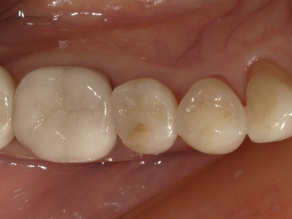 完成３｜【症例】銀歯の下に潜んだ虫歯をセラミックインレー（e.max）で修復治療｜港南台の歯医者 港南台パーク歯科クリニック