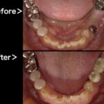 ビフォーアフター画像｜【症例】ブリッジが破損してしまった部位のインプラント治療｜港南台の歯医者 港南台パーク歯科クリニック