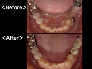 【症例】ブリッジが破損してしまった部位のインプラント治療