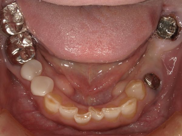 初診時画像|【症例】ブリッジが破損してしまった部位のインプラント治療|港南台の歯医者 港南台パーク歯科クリニック