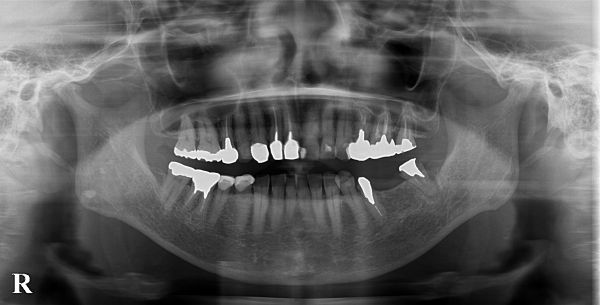 初診時レントゲン画像|【症例】ブリッジが破損してしまった部位のインプラント治療|港南台の歯医者 港南台パーク歯科クリニック