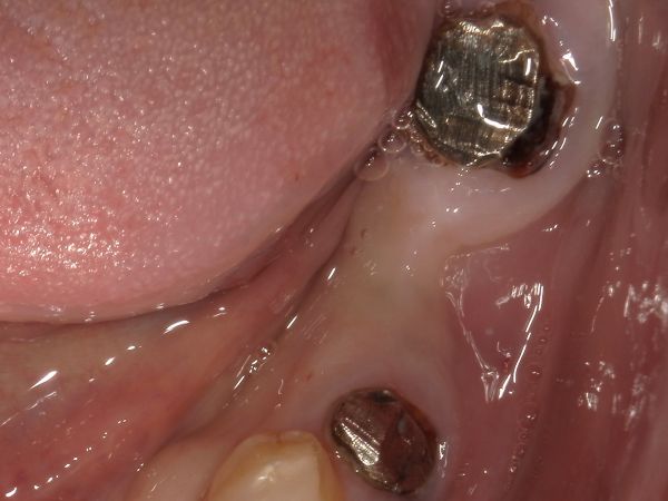 左下7番目画像|【症例】ブリッジが破損してしまった部位のインプラント治療|港南台の歯医者 港南台パーク歯科クリニック