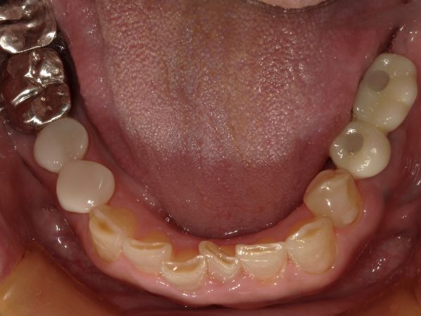 セット後写真|【症例】ブリッジが破損してしまった部位のインプラント治療|港南台の歯医者 港南台パーク歯科クリニック