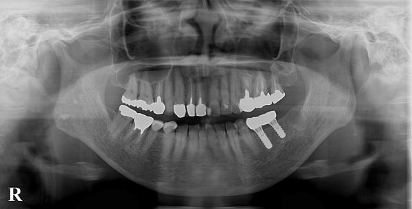 セット後レントゲン画像|【症例】ブリッジが破損してしまった部位のインプラント治療|港南台の歯医者 港南台パーク歯科クリニック
