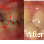 BeforeAfter画像｜【症例】亀裂が入ってしまった歯に対するインプラント治療｜港南台の歯医者 港南台パーク歯科クリニック