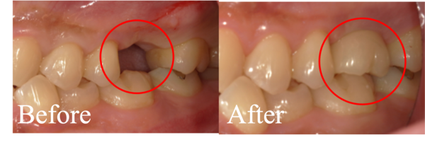 BeforeAfter画像｜【症例】亀裂が入ってしまった歯に対するインプラント治療｜港南台の歯医者 港南台パーク歯科クリニック