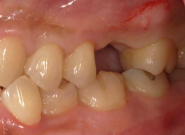 治療前口腔内画像｜【症例】亀裂が入ってしまった歯に対するインプラント治療｜港南台の歯医者 港南台パーク歯科クリニック