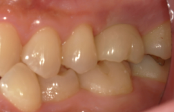 治療後口腔内画像｜【症例】亀裂が入ってしまった歯に対するインプラント治療｜港南台の歯医者 港南台パーク歯科クリニック