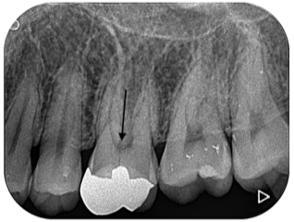 治療後レントゲン画像｜【症例】亀裂が入ってしまった歯に対するインプラント治療｜港南台の歯医者 港南台パーク歯科クリニック