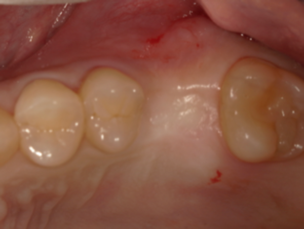 抜歯後口腔内画像｜【症例】亀裂が入ってしまった歯に対するインプラント治療｜港南台の歯医者 港南台パーク歯科クリニック