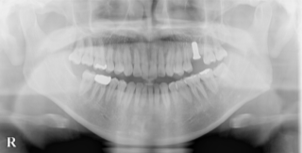 インプラント埋入後レントゲン画像｜【症例】亀裂が入ってしまった歯に対するインプラント治療｜港南台の歯医者 港南台パーク歯科クリニック