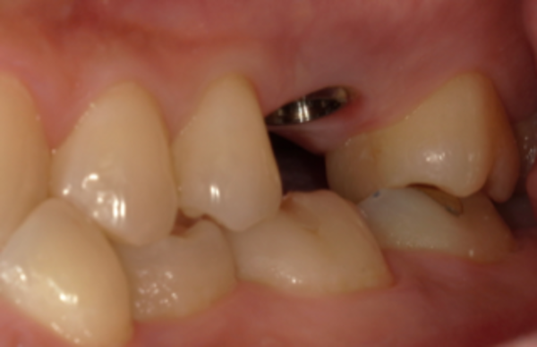 インプラント土台｜【症例】亀裂が入ってしまった歯に対するインプラント治療｜港南台の歯医者 港南台パーク歯科クリニック