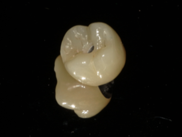 インプラントの被せ物｜【症例】亀裂が入ってしまった歯に対するインプラント治療｜港南台の歯医者 港南台パーク歯科クリニック