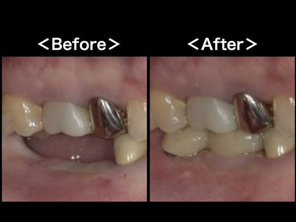BeforeAfter画像｜【症例】自覚症状のない歯根破折歯をインプラントで治療｜港南台の歯医者 港南台パーク歯科クリニック