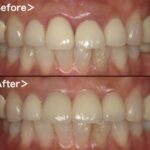 BeforeAfter画像｜【症例】歯根破折した前歯に対するインプラント治療｜港南台の歯医者 「港南台パーク歯科クリニック」