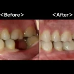 ビフォーアフター画像｜【症例】ブリッジを支える歯が重度の虫歯になりインプラントで機能を回復した治療｜港南台の歯医者「港南台パーク歯科クリニック」