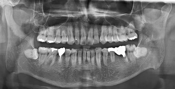治療前レントゲン画像|【症例】ブリッジを支える歯が重度の虫歯になりインプラントで機能を回復した治療|港南台の歯医者「港南台パーク歯科クリニック」