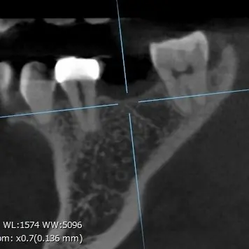 CT画像②｜【症例】ブリッジを支える歯が重度の虫歯になりインプラントで機能を回復した治療｜港南台の歯医者「港南台パーク歯科クリニック」