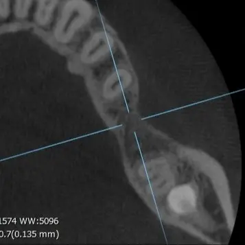 CT画像③|【症例】ブリッジを支える歯が重度の虫歯になりインプラントで機能を回復した治療|港南台の歯医者「港南台パーク歯科クリニック」