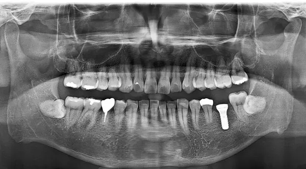 処置後レントゲン画像|【【症例】ブリッジを支える歯が重度の虫歯になりインプラントで機能を回復した治療|港南台の歯医者「港南台パーク歯科クリニック」