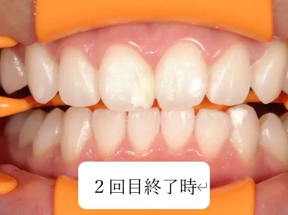 オフィスホワイトニング2回目終了時画像｜【症例】ICONとホワイトニングによるホワイトスポット治療｜港南台の歯医者「港南台パーク歯科クリニック」